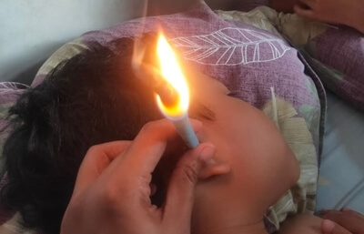 terapi-bekam-hca-omah-nisa-malang